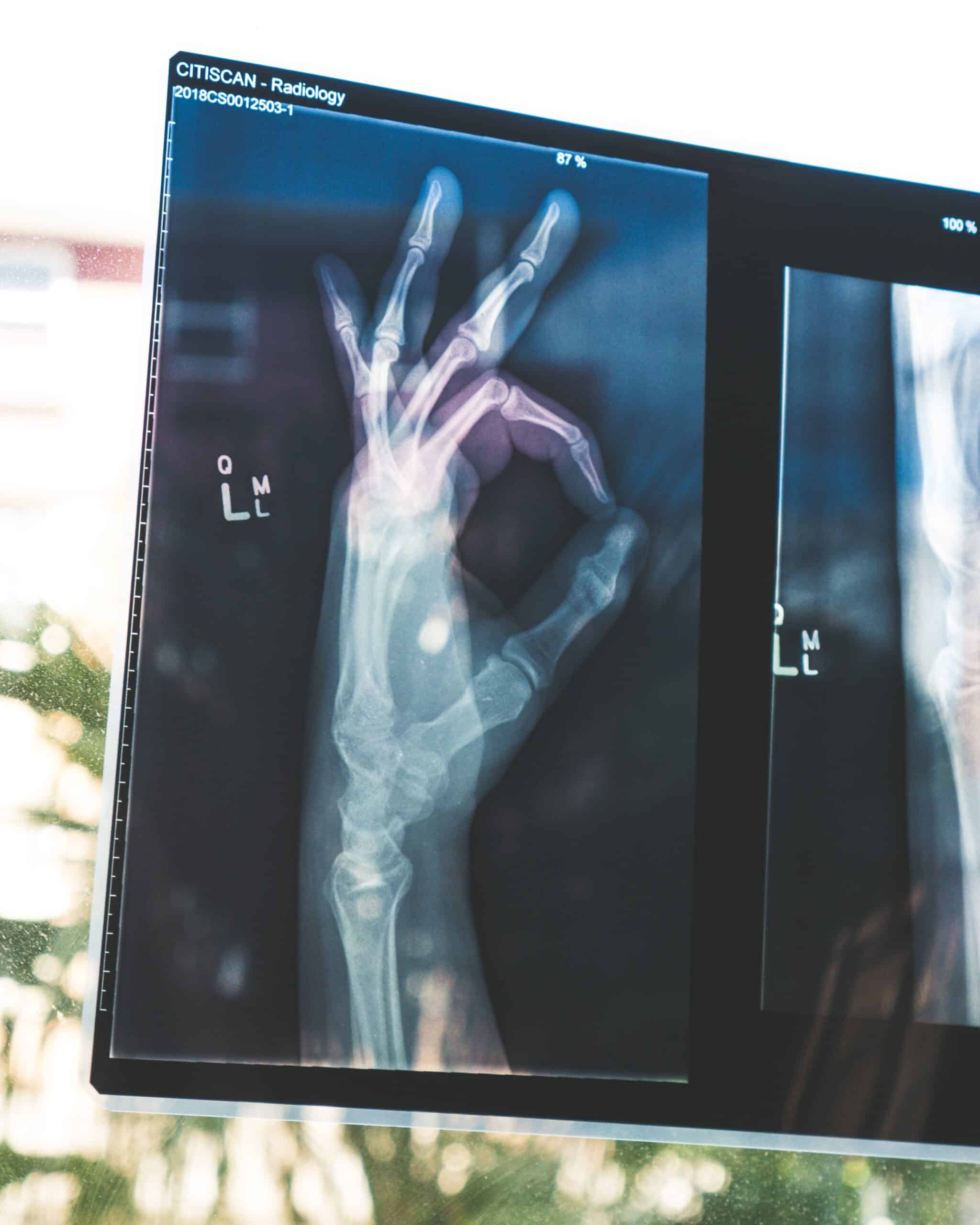 health x ray of a hand doing ok sign